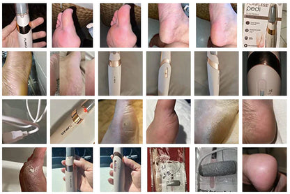 Rough Skin Remedy™ | Electric foot Callus Remover